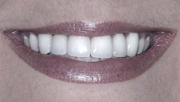 results of porcelain crowns