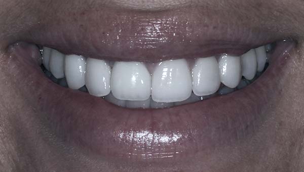 results of dental veneers
